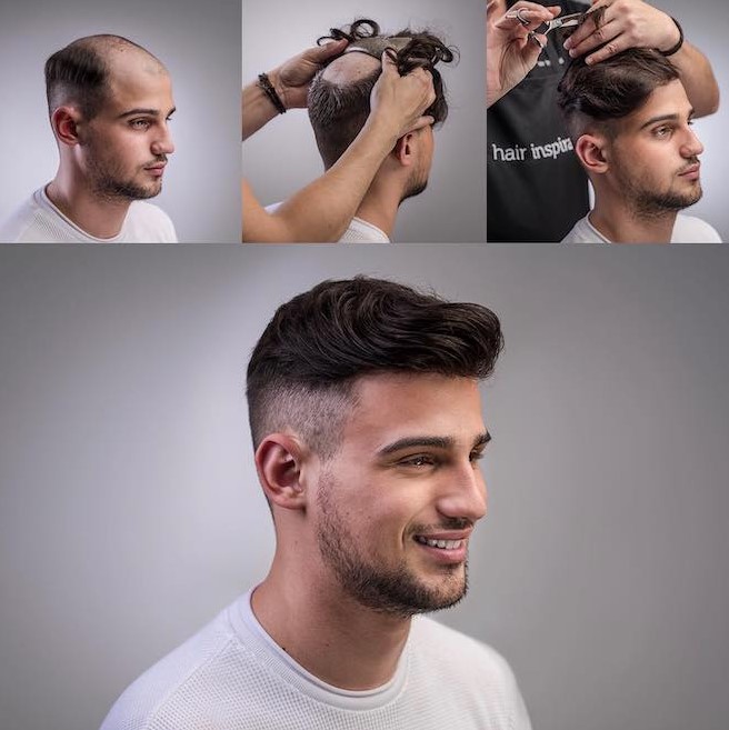 protesis pelo hombre
